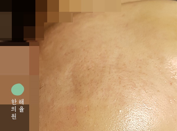 [울산점] 여드름흉터 치료 후 사진 - 해율한의원